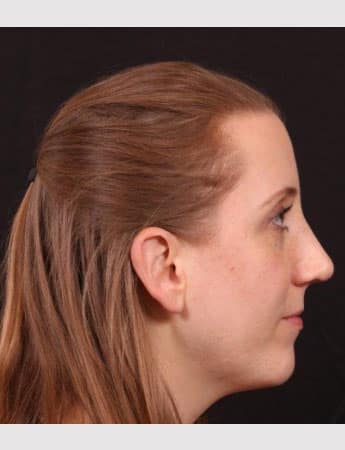 After Image: Rhinoplasty - right-side