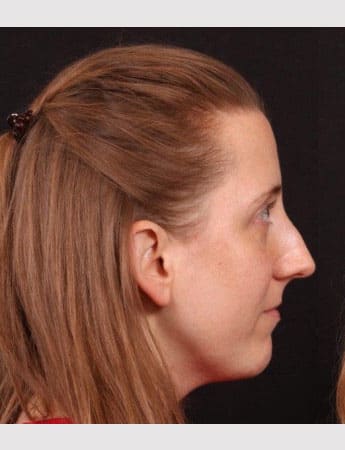 Before Image: Rhinoplasty - right-side