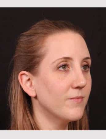 After Image: Rhinoplasty - right-front-oblique