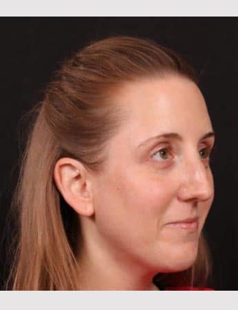 Before Image: Rhinoplasty - right-front-oblique