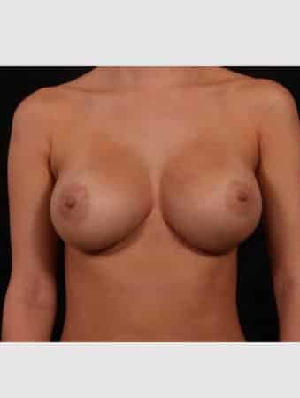 After Image: Breast Augmentation - front