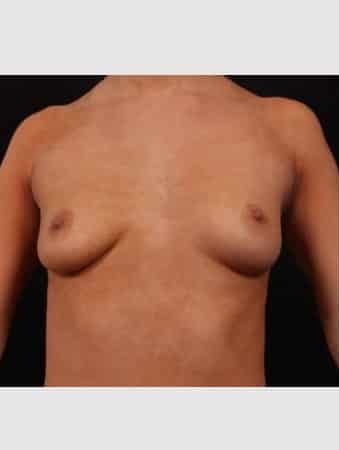 Before Image: Breast Augmentation - front