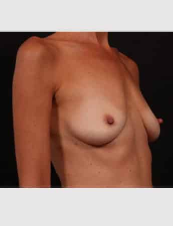 After Image: Implant Removal - right-front-oblique