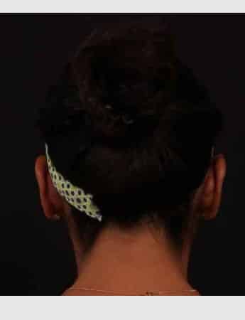 After Image: Otoplasty -