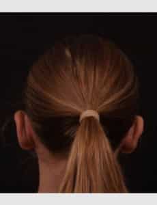 Otoplasty