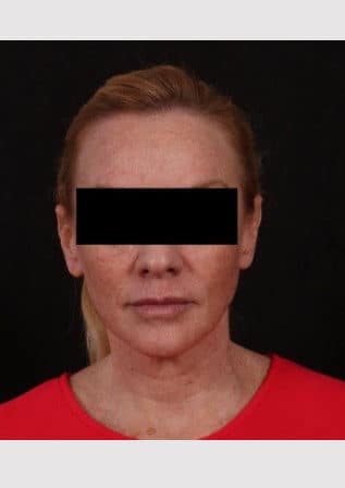 Before Image: Lower Facelift and Temporal Brow with Full Face TCA Chemical Peel - front