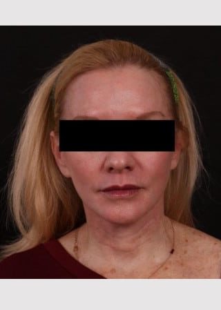 Lower Facelift and Temporal Brow with Full Face TCA Chemical Peel