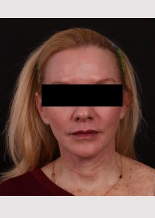After Image: Lower Facelift and Temporal Brow with Full Face TCA Chemical Peel - front