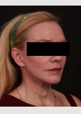 After Image: Lower Facelift and Temporal Brow with Full Face TCA Chemical Peel - other