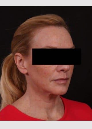 Before Image: Lower Facelift and Temporal Brow with Full Face TCA Chemical Peel - other