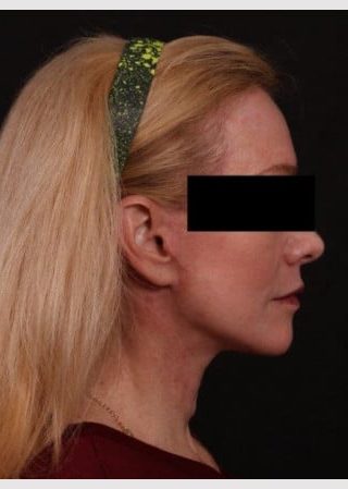 After Image: Lower Facelift and Temporal Brow with Full Face TCA Chemical Peel - right-side