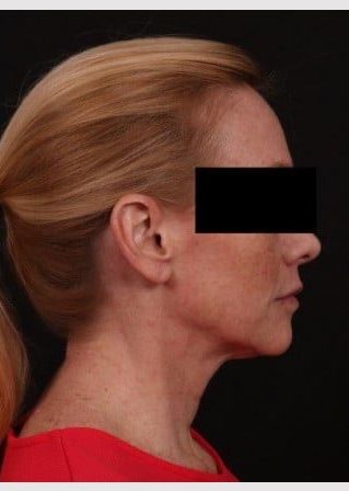 Before Image: Lower Facelift and Temporal Brow with Full Face TCA Chemical Peel - right-side