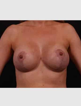 After Image: Breast Lift (Mastopexy) with Augmentation - front