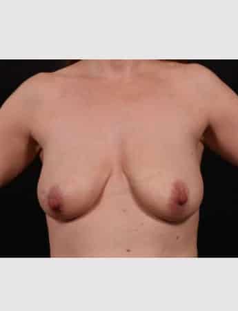 Before Image: Breast Lift (Mastopexy) with Augmentation - front