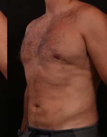 After Image: Male Gynecomastia and Liposuction - left-front-oblique