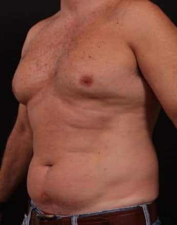 Before Image: Male Gynecomastia and Liposuction - left-front-oblique