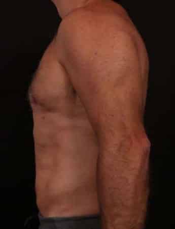 After Image: Male Gynecomastia and Liposuction - left-side