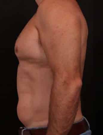 Before Image: Male Gynecomastia and Liposuction - left-side