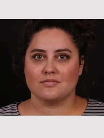 After Image: Neck Liposuction - front