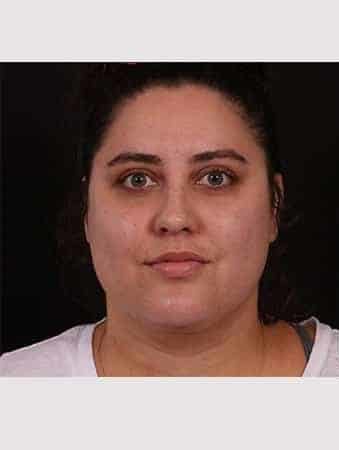 Before Image: Neck Liposuction - front