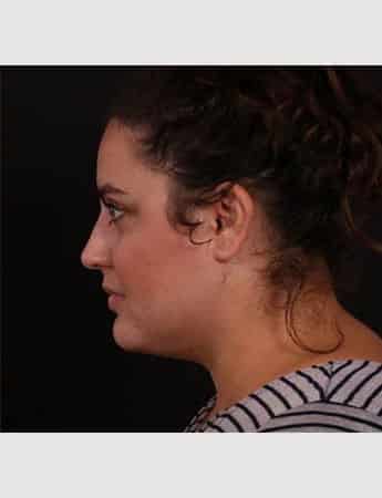 After Image: Neck Liposuction - left-side
