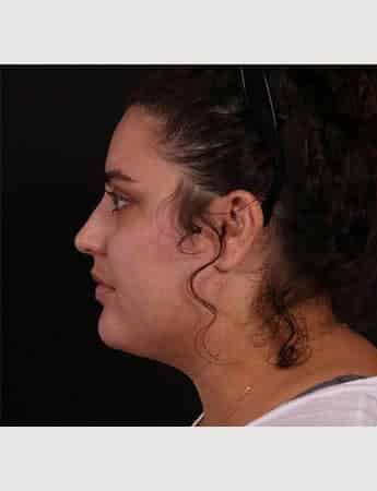 Before Image: Neck Liposuction - left-side