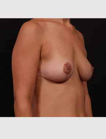 After Image: Implant Removal with Mastopexy - right-front-oblique