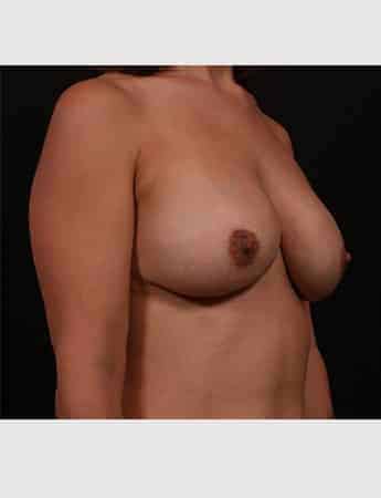 Before Image: Implant Removal with Mastopexy - right-front-oblique
