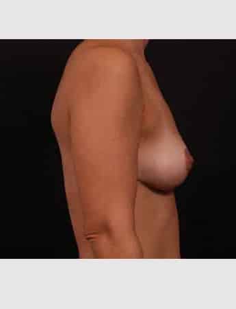 After Image: Implant Removal with Mastopexy - right-side