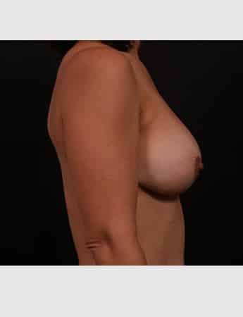 Before Image: Implant Removal with Mastopexy - right-side