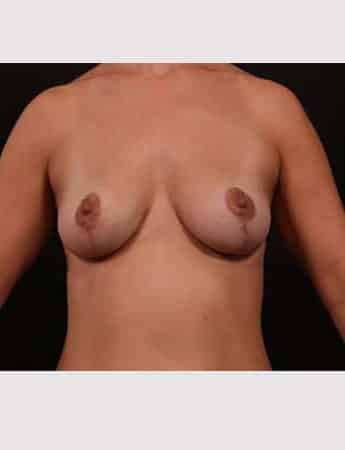 After Image: Implant Removal with Mastopexy - front