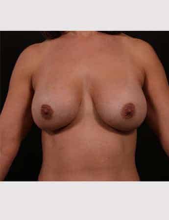 Before Image: Implant Removal with Mastopexy - front