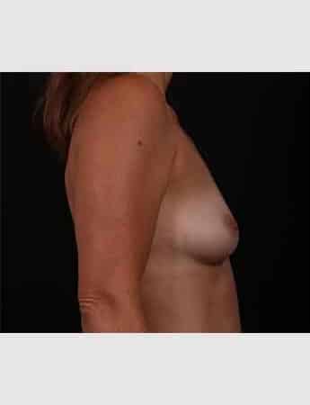 Before Image: Breast Augmentation with Peri Areolar Lift - right-side