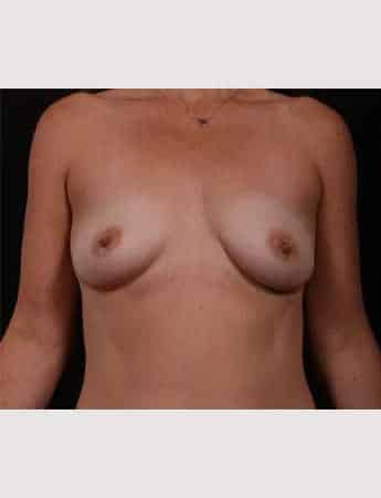 Before Image: Breast Augmentation with Peri Areolar Lift - front