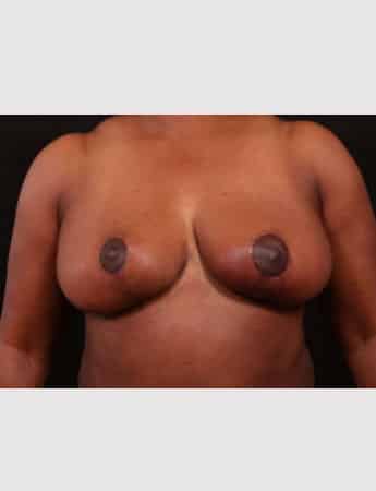 After Image: Breast Reduction - front