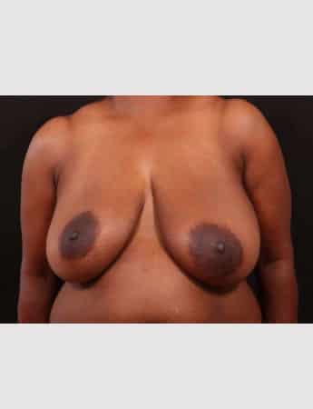 Before Image: Breast Reduction - front