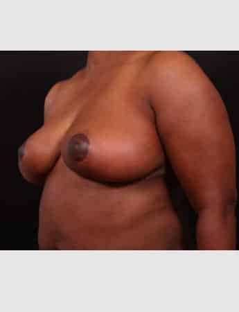 After Image: Breast Reduction - left-front-oblique