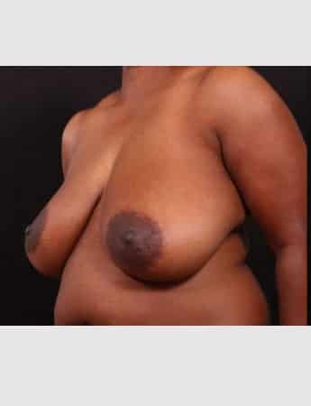 Before Image: Breast Reduction - left-front-oblique