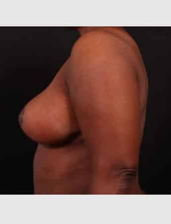 After Image: Breast Reduction - left-side