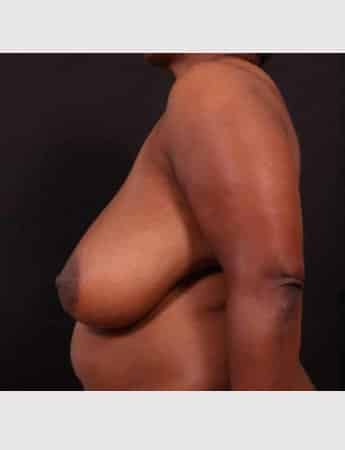 Before Image: Breast Reduction - left-side