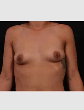 Before Image: Breast Augmentation - front