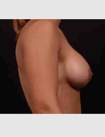 After Image: Breast Augmentation - right-side