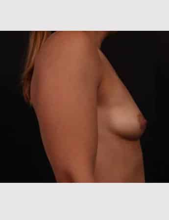 Before Image: Breast Augmentation - right-side