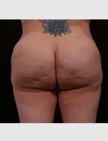 After Image: Brazilian Butt Augmentation (Butt Lift) - back
