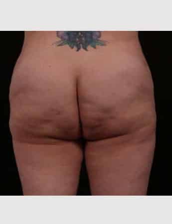 Before Image: Brazilian Butt Augmentation (Butt Lift) - back