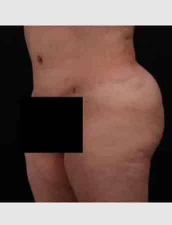 After Image: Brazilian Butt Augmentation (Butt Lift) - left-front-oblique
