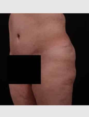 Before Image: Brazilian Butt Augmentation (Butt Lift) - left-front-oblique