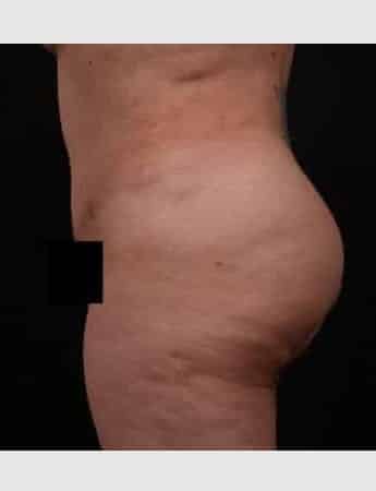After Image: Brazilian Butt Augmentation (Butt Lift) - left-side