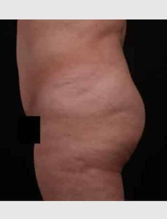 Before Image: Brazilian Butt Augmentation (Butt Lift) - left-side