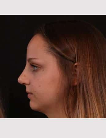 After Image: Rhinoplasty - left-side